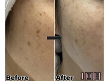 ヤエの雰囲気（新機種THR（SHR;＋IPL）強力スポット照射による集中ケア。）