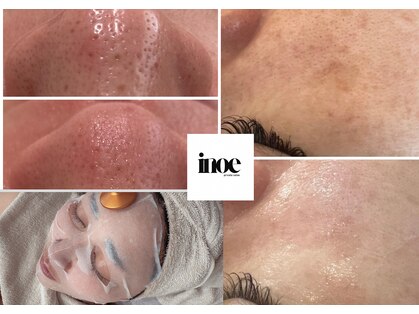 ≪毛穴/ニキビケア/くすみ/シミケア≫ inoe private salon【イノエ】の写真
