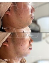 アルフォービューティー 難波店(ALU for beauty)/オンダリフト症例