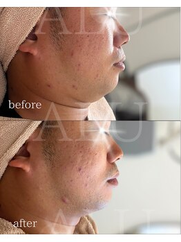 アルフォービューティー 難波店(ALU for beauty)/オンダリフト症例