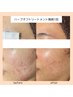 《人気No.2》剥けないハーブピーリングで徹底肌質改善！