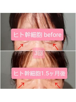 エルアンドエス(L&S)/ヒト幹細胞2週間おき3回の効果！