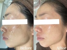 パールホワイトニングの雰囲気（最新幹細胞のハーブピーリングで透明感ある輝く素肌へ三島エステ）