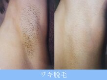 オーシャンブルー 長崎店(OCEAN BLUE)/結果が出る脱毛！ワキ脱毛