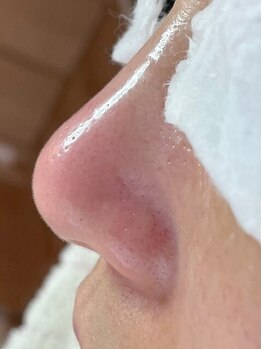 リリハ(Liliha)/一度の施術で変化を実感！