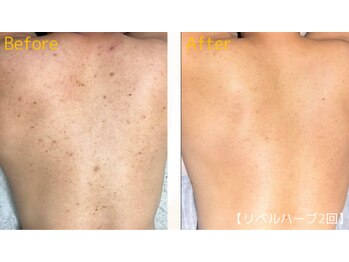 ロイヤリティ(ROYALTY)/背中のシミ/ニキビケア