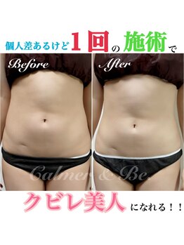 カルマーアンドビー(Calmer & Be.)/【レディース痩身】Before/After