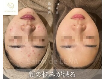 サロンドレナ 名駅店/ハーブピーリング サロンドレナ