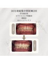 プラスビーセルフ(+b self)/ホワイトニングビフォーアフター