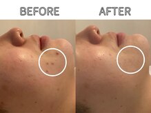 ライム バイ アネラ 高崎(LIME By Anela)/ハーブピーリング/肌質改善