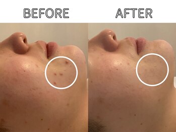 ライム バイ アネラ 高崎(LIME By Anela)/ハーブピーリング/肌質改善