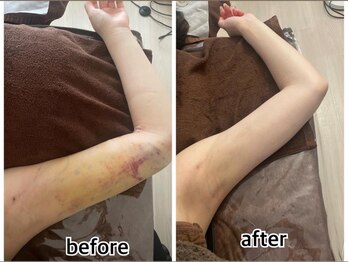 インディバジェム(GEM)/ビフォーアフター