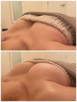 美人バスト 町田店/バストアップ◇症例◇