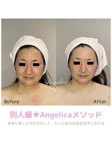 アンジェリカ(Angelica)/小顔/透明感/たるみケア/法令線