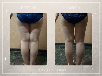 アバンダンティア 姫路店/脂肪冷却