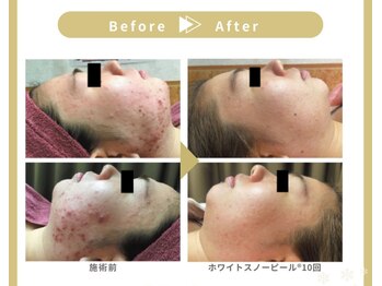 エル ブランシュ(Ailes blanches)/ホワイトスノーピール