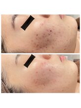 ジャスミン(Jasmin)/プラペン×幹細胞