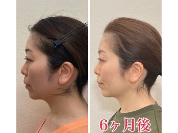 小顔22 ボルティ 赤坂支店(Bolty)/小顔シンメトリー矯正＆全身矯正