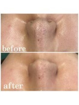 オーシャンブルー 時津店(OCEAN BLUE)/ダイヤモンドピーリング症例