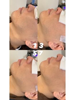 ゴールデンエイジ(Golden Age)/【ヒゲ脱毛】Before&After