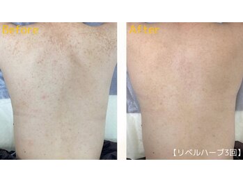 ロイヤリティ(ROYALTY)/背中ニキビケア