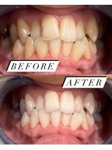 ヘーラー(Hera)/【施術例】セルフホワイトニング