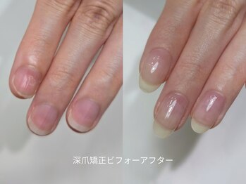 ミンスネイル(Mins Nail)/深爪矯正ビフォーアフター