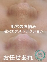サロンド シェリー(Salon de Cherie)/毛穴エクストラクション