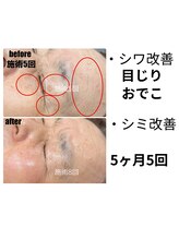 ビープラス(Biplus)/【60代お悩み】しわ・シミ改善