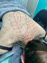 高宮レディース鍼灸整骨院/ルート鍼