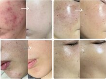 ダイヤモンドビューティーの雰囲気（ダウンタイム有タイプの本格的ハーブピーリングが断然効果が高い）