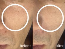 アンリミット 鹿児島天文館店(Une limit)/開き毛穴ケア