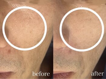 アンリミット 鹿児島天文館店(Une limit)/開き毛穴ケア