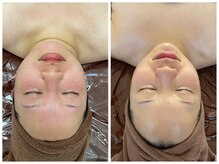 エスプレッソ(espresso,)/【小顔コルギ5回】