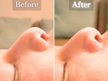 ボーンオム(Born Homme)/毛穴洗浄＋美容液導入：20代男性