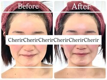 シェリール(Cherir)/小顔コルギ　1回の変化