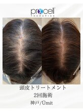 ユミト(Umit)/プロセルスカルプ