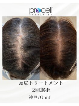 ユミト(Umit)/プロセルスカルプ