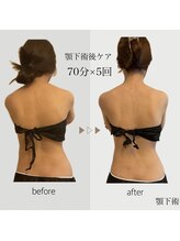 ファミーユ 名古屋店/【術後ケア】顎下吸引後ケア