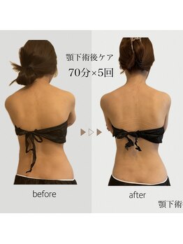 ファミーユ 名古屋店/【術後ケア】顎下吸引後ケア