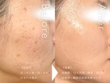 セルフミー 恵比寿(SELF Me...)の雰囲気（毎月100名以上が肌の変化を実感！ニキビケア＆肌荒れ改善♪）