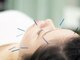 パーム(PALM)の写真/美容鍼で肌の奥まで刺激することにより血行が促進され、肌のトーンUPやたるみを改善◎【平岸駅徒歩5分】
