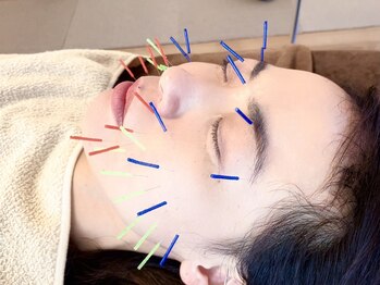 ミフール鍼灸院の写真/美容鍼でお顔をリフトアップ【全身マッサージ付き美容鍼】シワ・くすみ・たるみ改善に★90分¥10500→¥8500