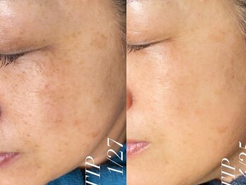 ダリア(Dahlia)/エイジングにもハーブピーリング