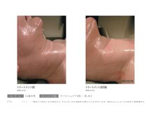 ピカイチ 上通店(pikAicHi)/サーモシェイプ