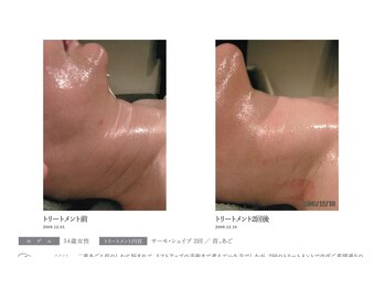 ピカイチ 上通店(pikAicHi)/サーモシェイプ