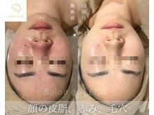 サロンドレナ 名駅店/ハーブピーリング サロンドレナ