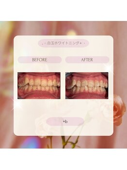 プラスビーセルフ(+b self)/ホワイトニングビフォーアフター