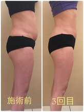 アールボディバランス/【加圧スリム矯正】お腹スッキリ