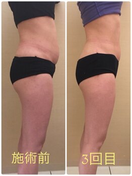 アールボディバランス/【加圧スリム矯正】お腹スッキリ